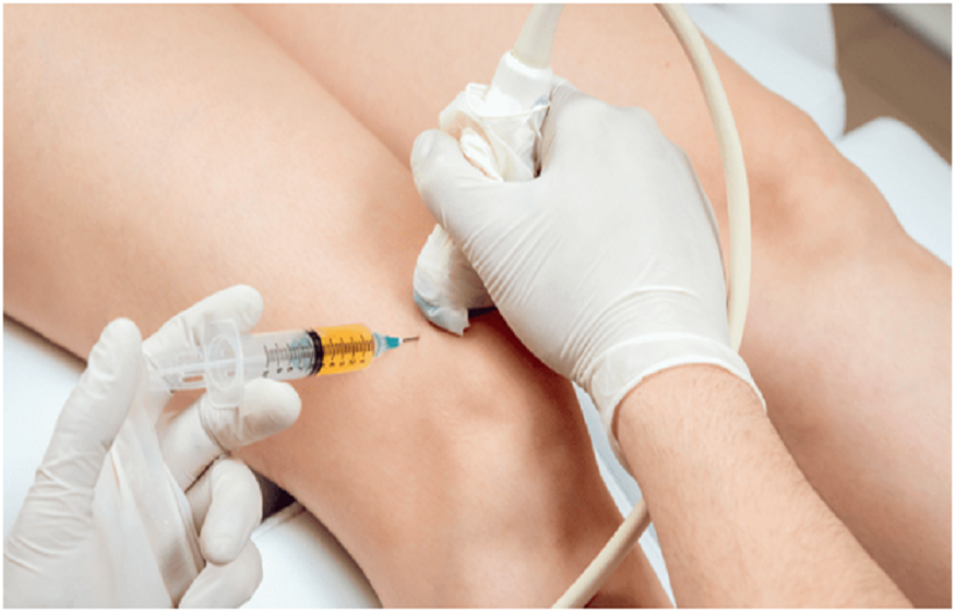PRP Treatment St Petersburg FL.
